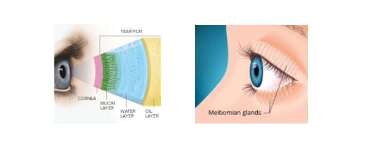 mgd meibomian gland disease